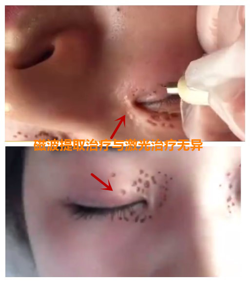 磁波提取治疗汗管瘤的表现