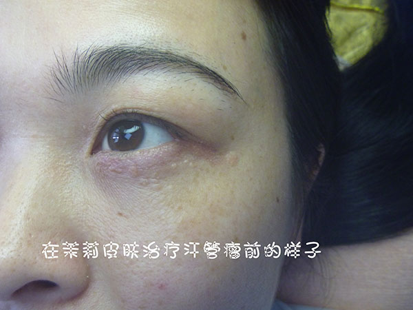 深圳茉莉皮肤治疗汗管瘤前后对比图