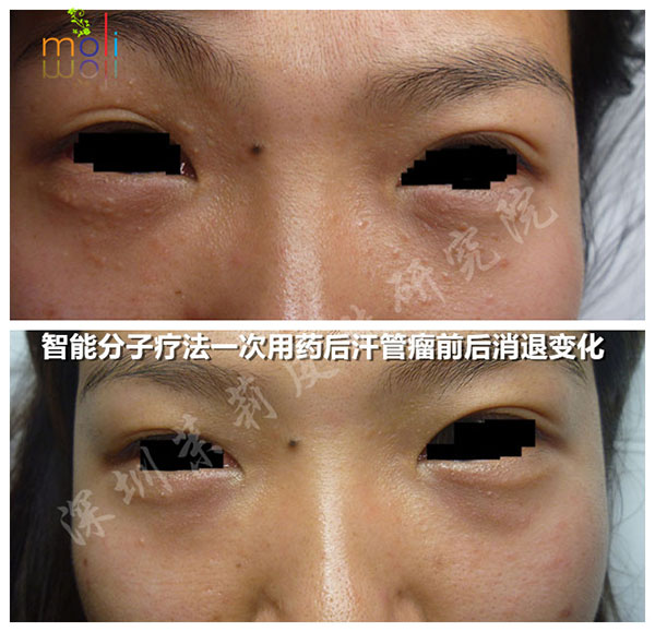 祛除汗管瘤后需要哪些事项?做到这些,汗管瘤恢复效果更加好(图1) 深圳茉莉皮肤祛除汗管瘤一次后前后对比图