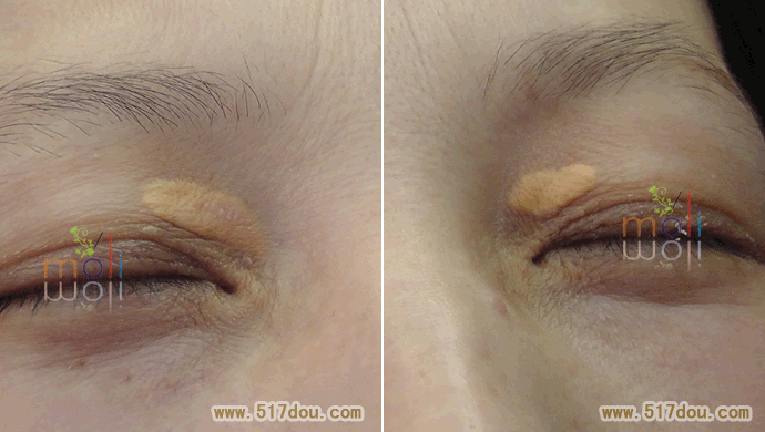 睑黄瘤(图1) 睑黄瘤