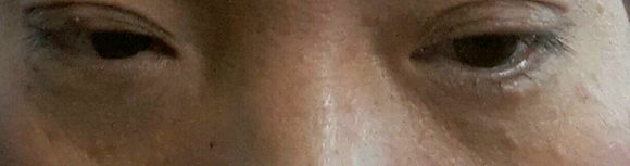 脸部小疙瘩 脸上长小疙瘩、除了可能是汗管瘤,还可能是这些疾病(图5)