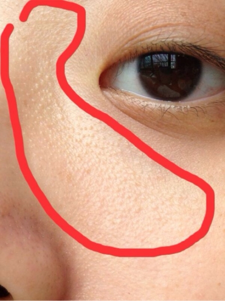 脸上长小疙瘩、除了可能是汗管瘤,还可能是这些疾病(图9) 汗腺粗大