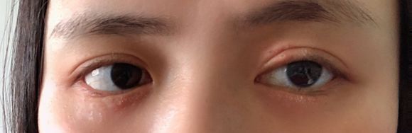 脸部小疙瘩 脸上长小疙瘩、除了可能是汗管瘤,还可能是这些疾病(图6)