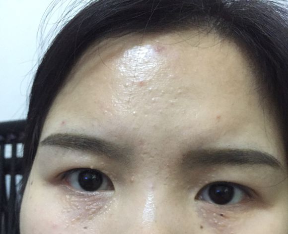 脸上长小疙瘩、除了可能是汗管瘤,还可能是这些疾病(图3) 脸部小疙瘩