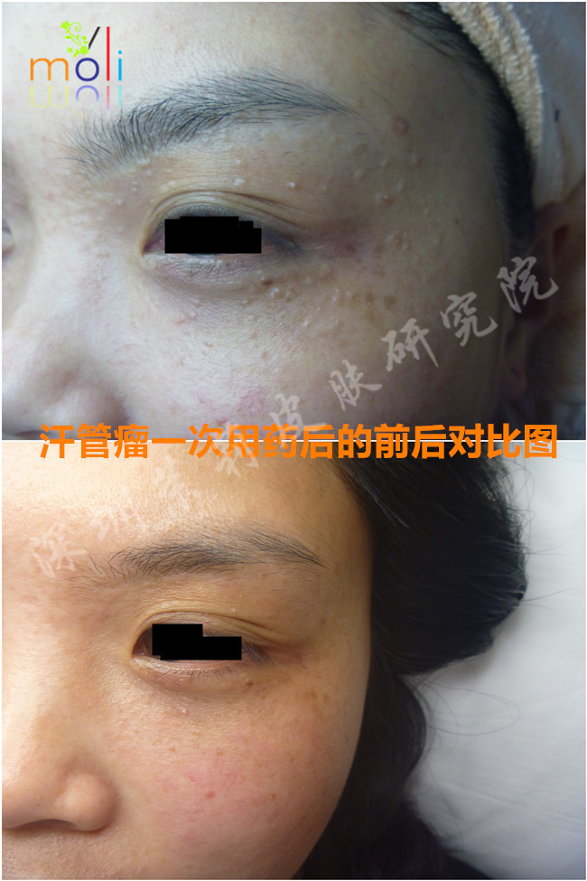 脸上长小疙瘩、除了可能是汗管瘤,还可能是这些疾病(图7) 智能分子疗法