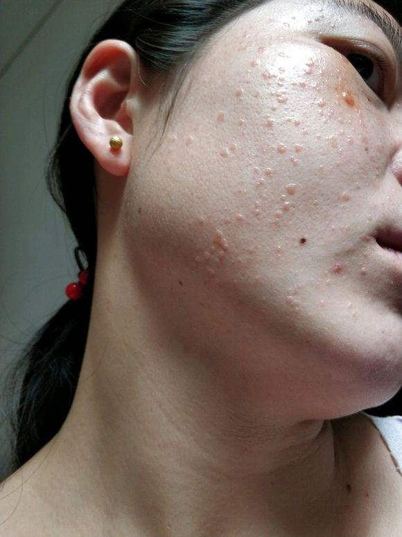 脸部小疙瘩 脸上长小疙瘩、除了可能是汗管瘤,还可能是这些疾病(图4)