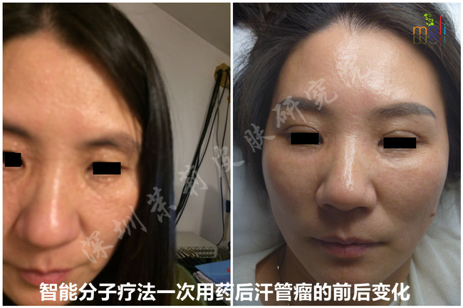 汗管瘤痒,能用炉甘石洗剂止痒吗?(图1) 深圳茉莉皮肤去除汗管瘤前后对比图