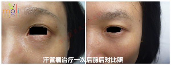 智能分子疗法治疗眼部汗管瘤的前后变化 智能分子疗法治疗眼部汗管瘤的前后变化