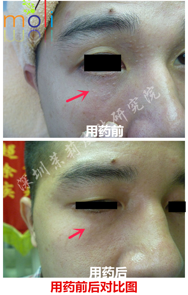 智能分子疗法治疗眼部汗管瘤的前后变化 智能分子疗法治疗眼部汗管瘤的前后变化