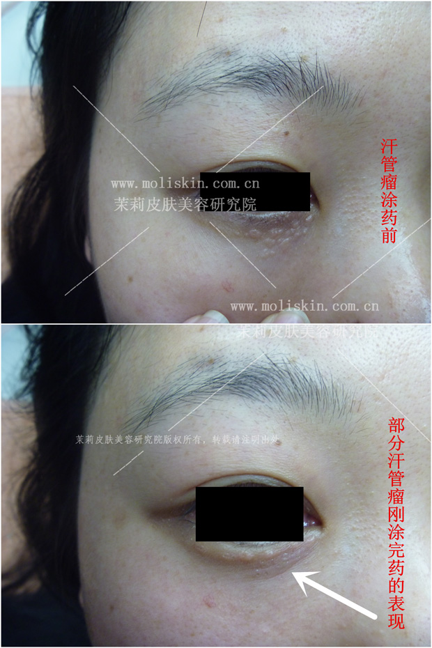 部分汗管瘤刚涂完药的前后对比图 部分汗管瘤刚涂完药的前后对比图