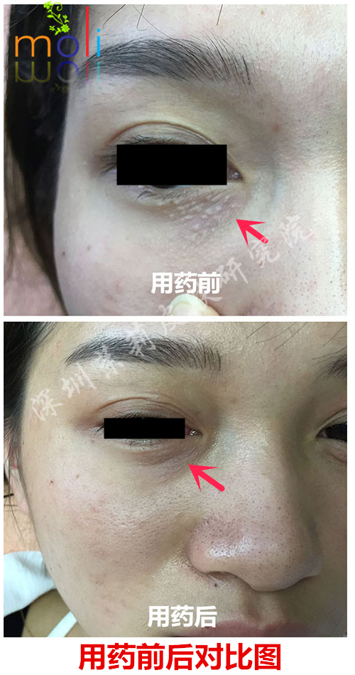 智能分子疗法治疗眼部汗管瘤的前后变化 智能分子疗法治疗眼部汗管瘤的前后变化