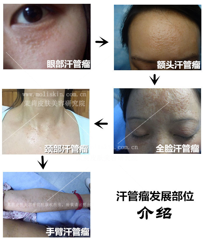 汗管瘤发展部位介绍 汗管瘤发展部位介绍