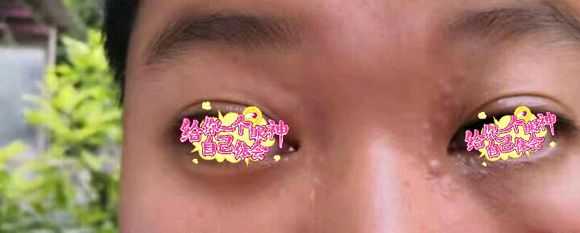 眼部汗管瘤治疗前 眼部汗管瘤治疗前