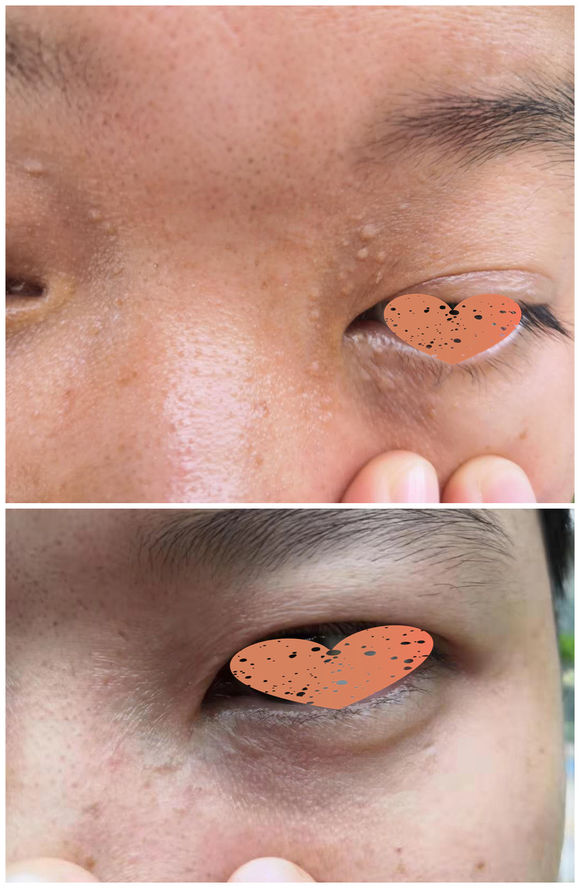 汗管瘤治疗后一个月的样子 汗管瘤治疗后一个月的样子