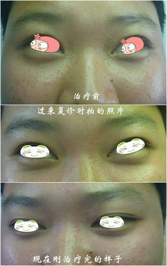 汗管瘤治疗过程照片 汗管瘤治疗过程照片