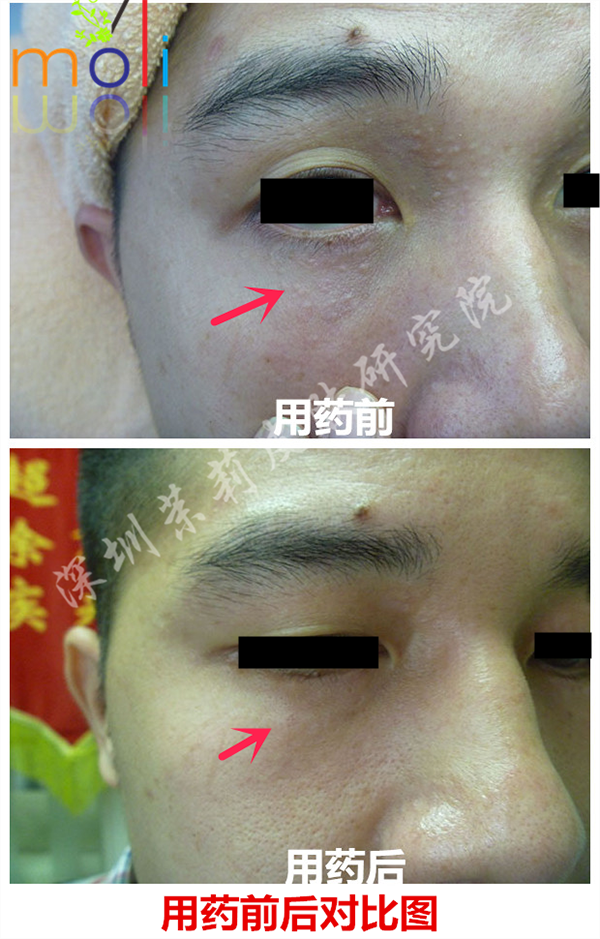 智能分子疗法涂药后汗管瘤的消退情况
