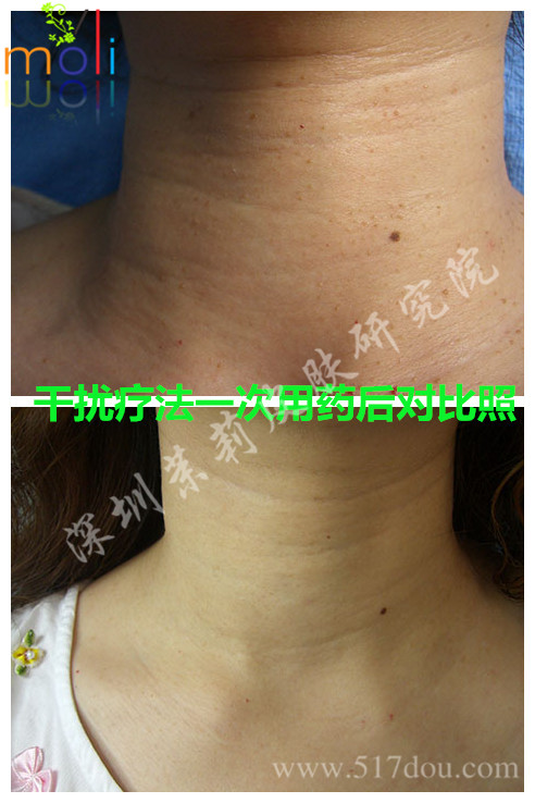 扁平疣g 扁平疣