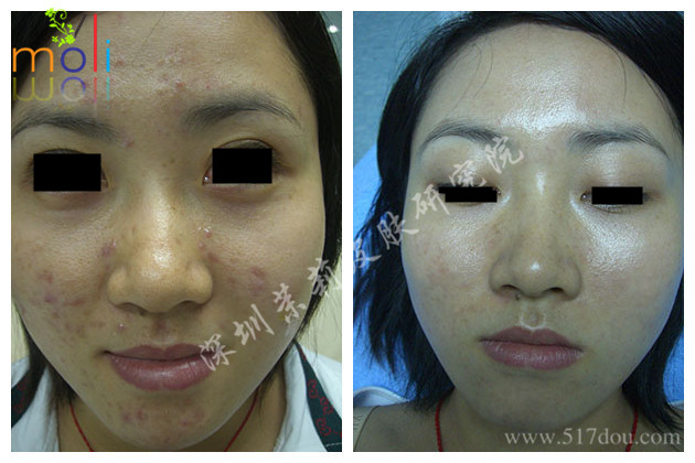 深圳茉莉皮肤去除青春痘 深圳茉莉皮肤去除青春痘