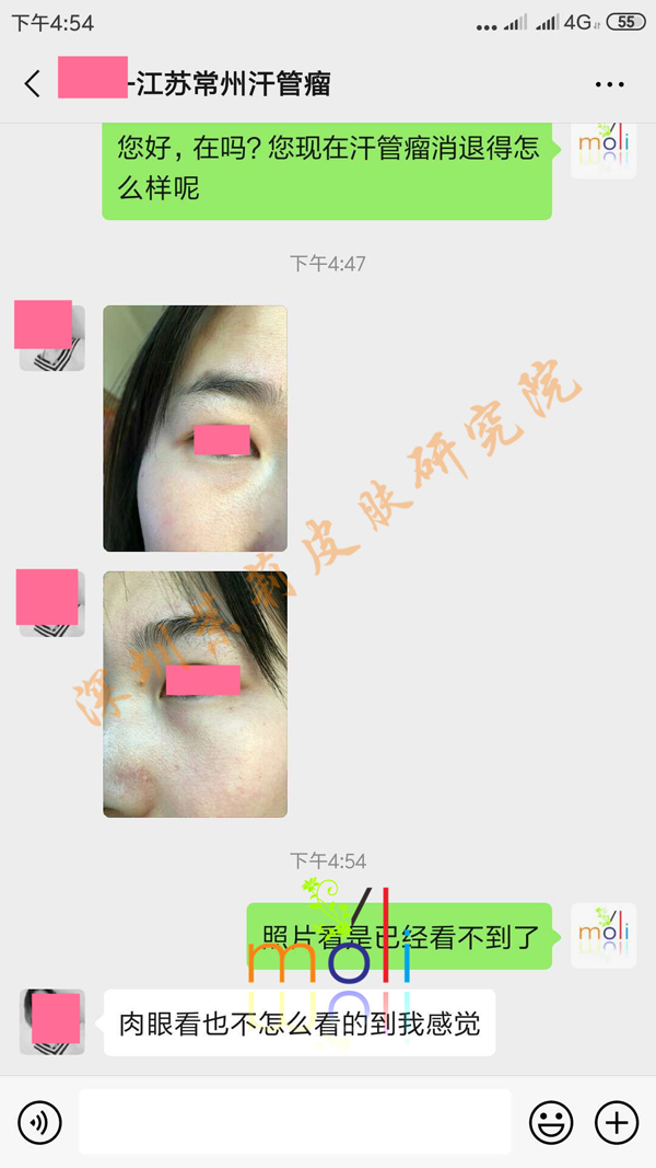 汗管瘤聊天记录 汗管瘤聊天记录