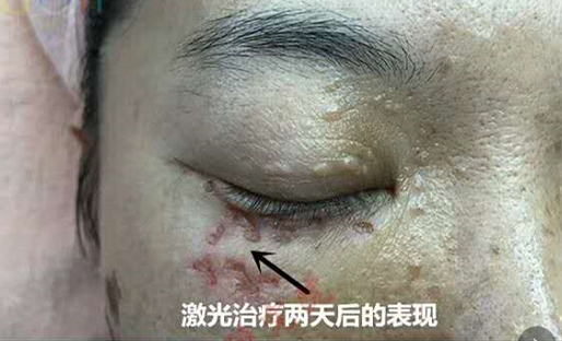 激光治疗汗管瘤