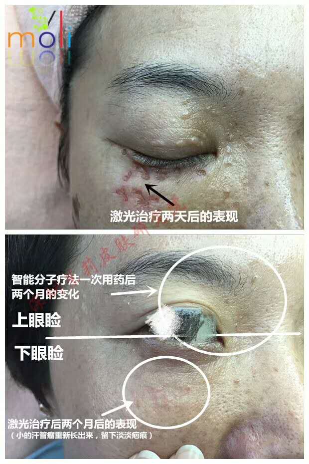 智能分子疗法和激光哪种方法做汗管瘤效果效果好