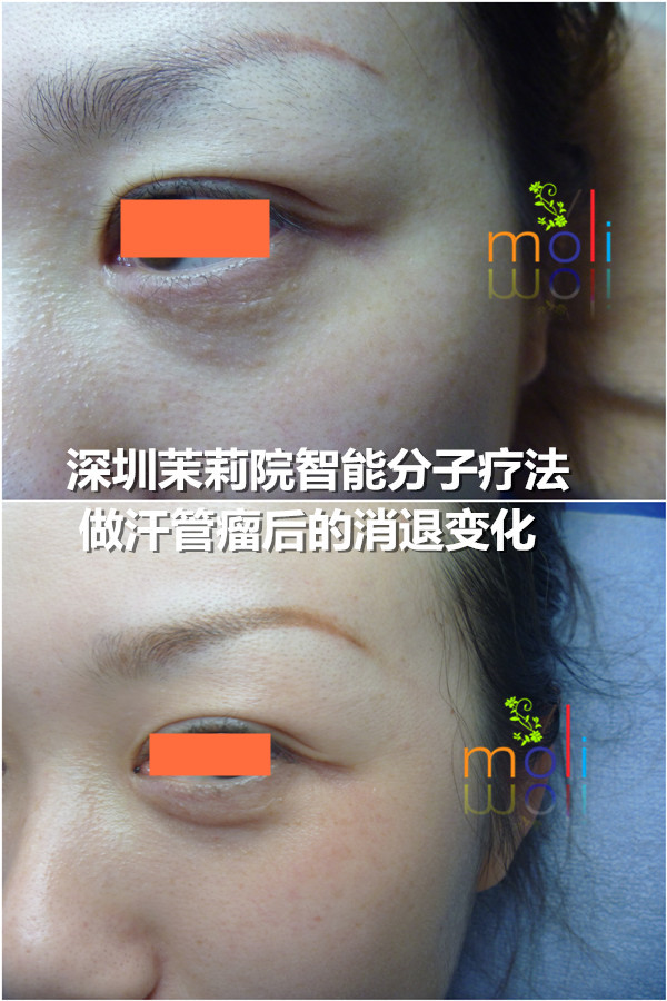 如何去除脸上的汗管瘤?亲戚为26岁单身女孩子介绍这种方法(图4) 如何去除脸上的汗管瘤?亲戚为26岁单身女孩子介绍这种方法(图4)