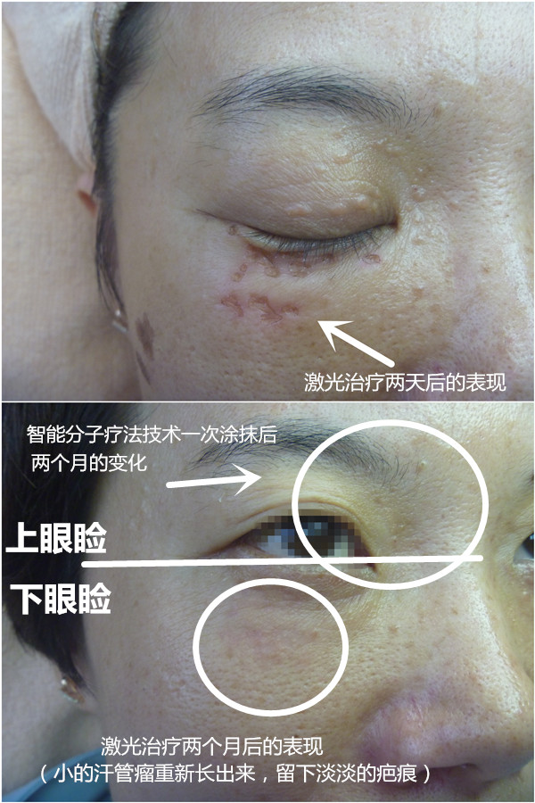 外地汗管瘤美巡时间出来啦，送价值500元护肤产品(图3)