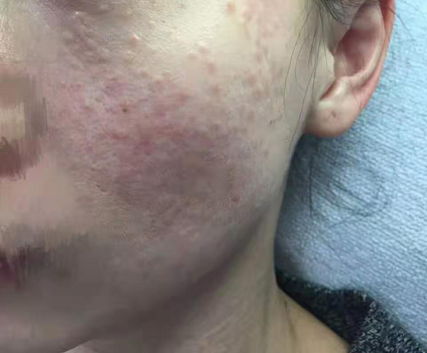 汗管瘤痘痘 汗管瘤痘痘