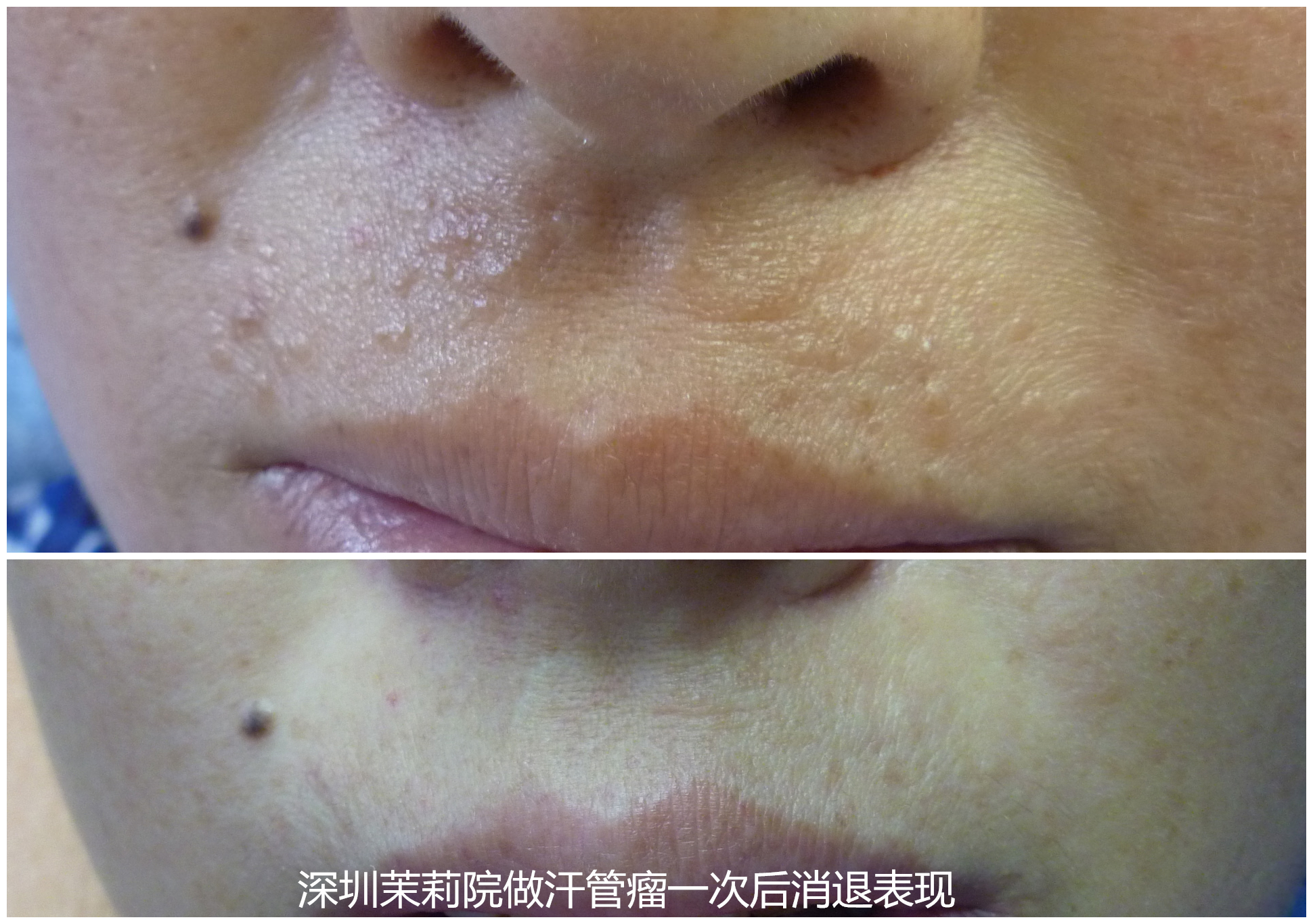 汗管瘤