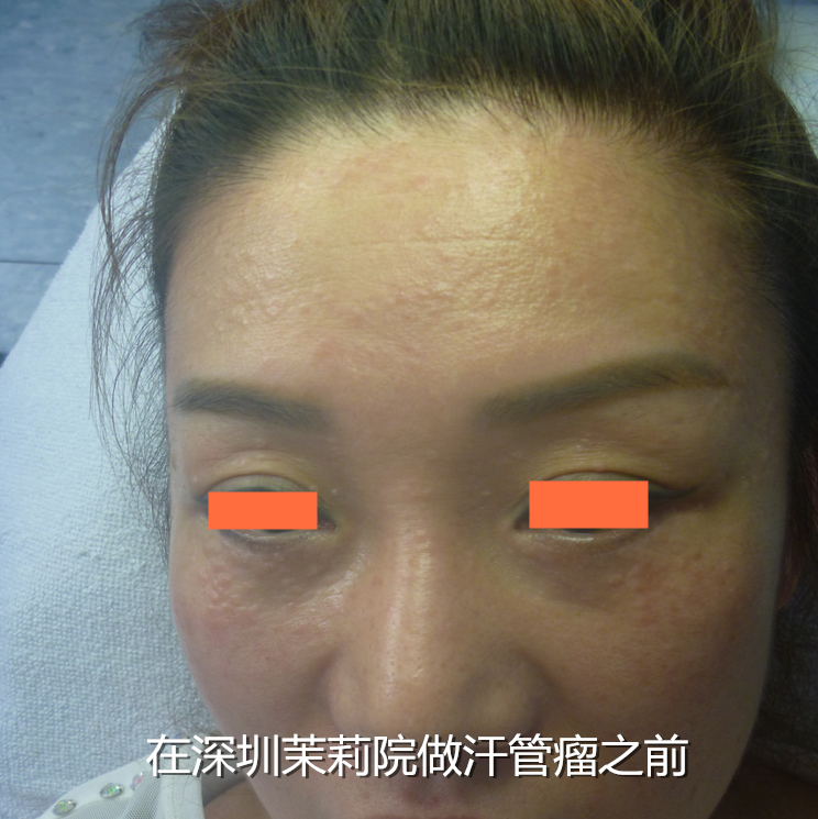 汗管瘤