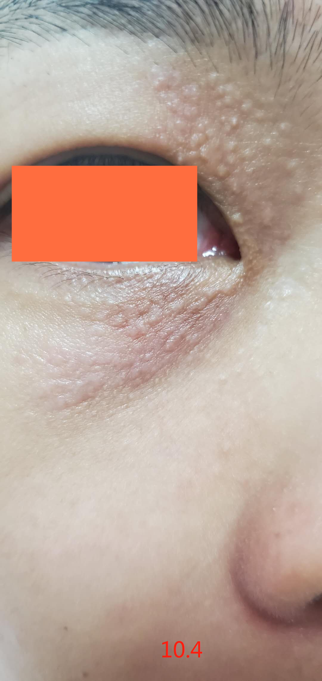 记录汗管瘤三个月的消退变化,每隔一个月变一样(图3) 记录汗管瘤三个月的消退变化,每隔一个月变一样(图3)