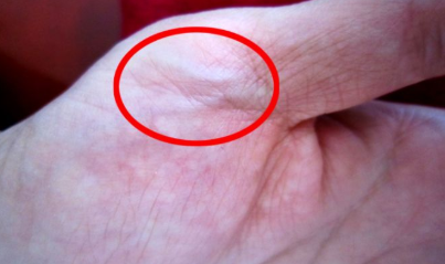 定时间啦!即将到上海北京进行汗管瘤美巡,预约的人太多了(图2) 定时间啦!即将到上海北京进行汗管瘤美巡,预约的人太多了(图2)