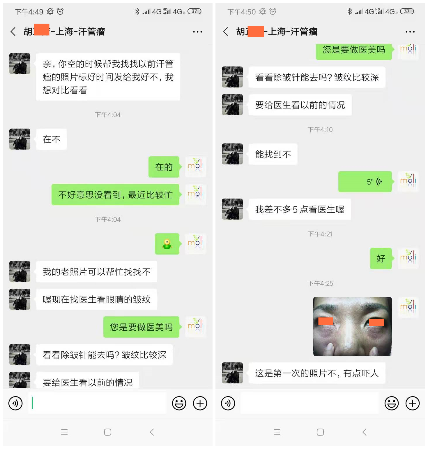 汗管瘤g 汗管瘤