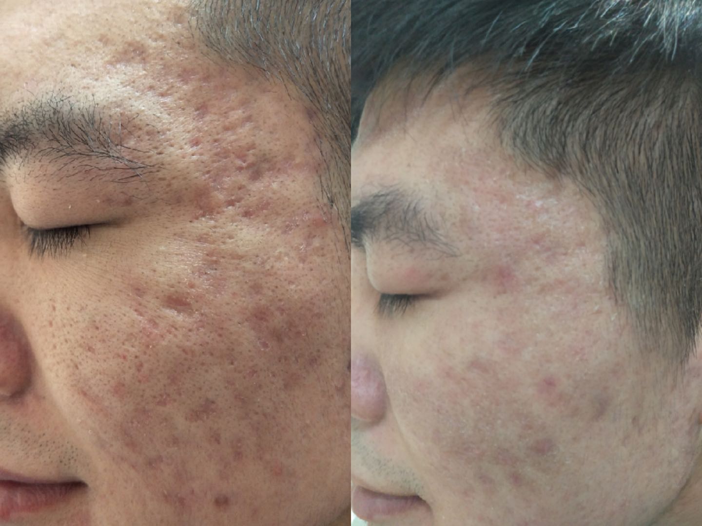 痘印痘疤 痘印痘疤