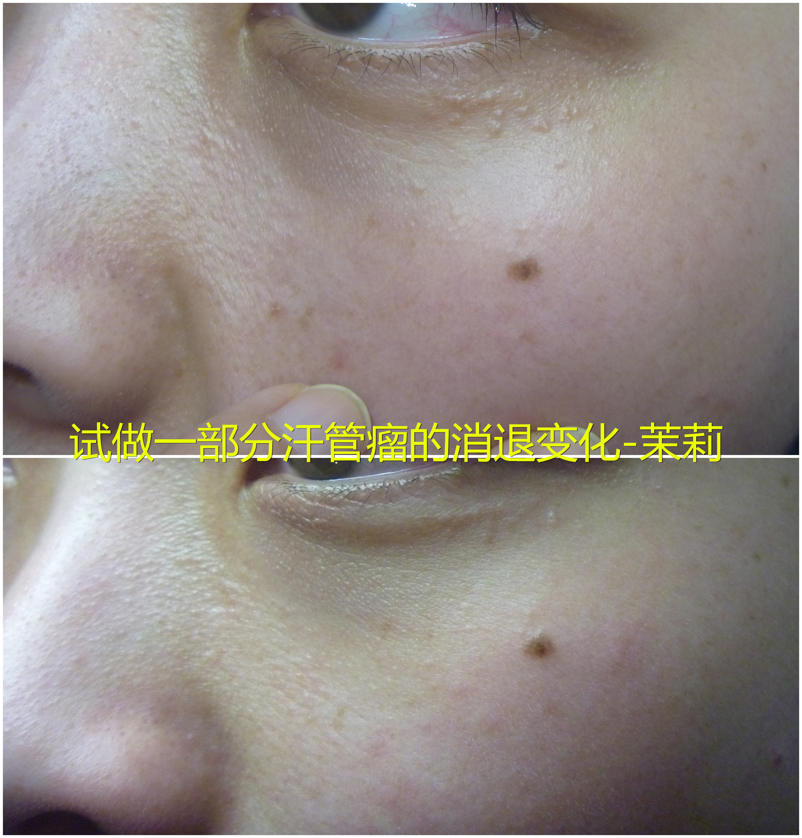 汗管瘤