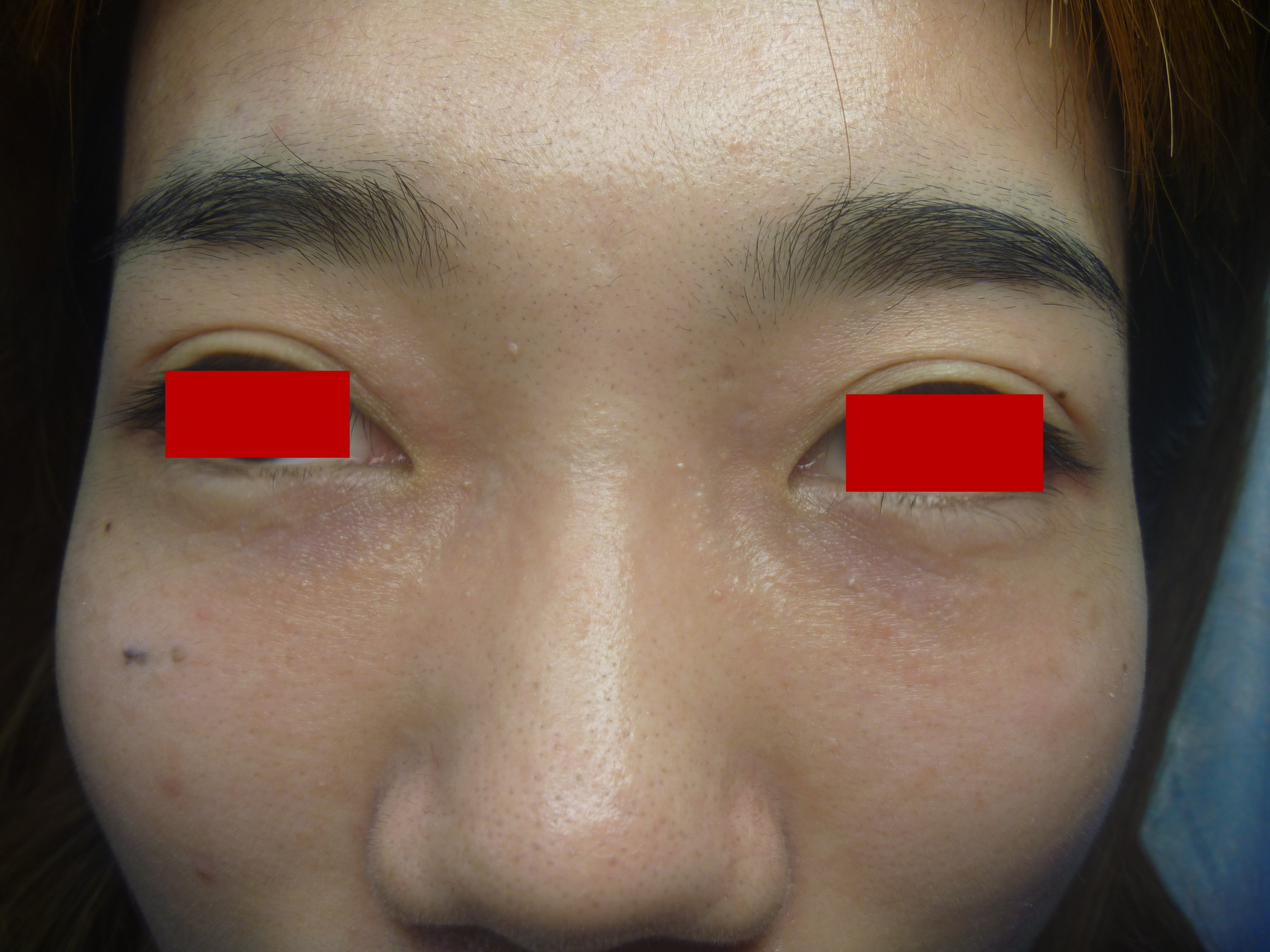 汗管瘤做一次的变化