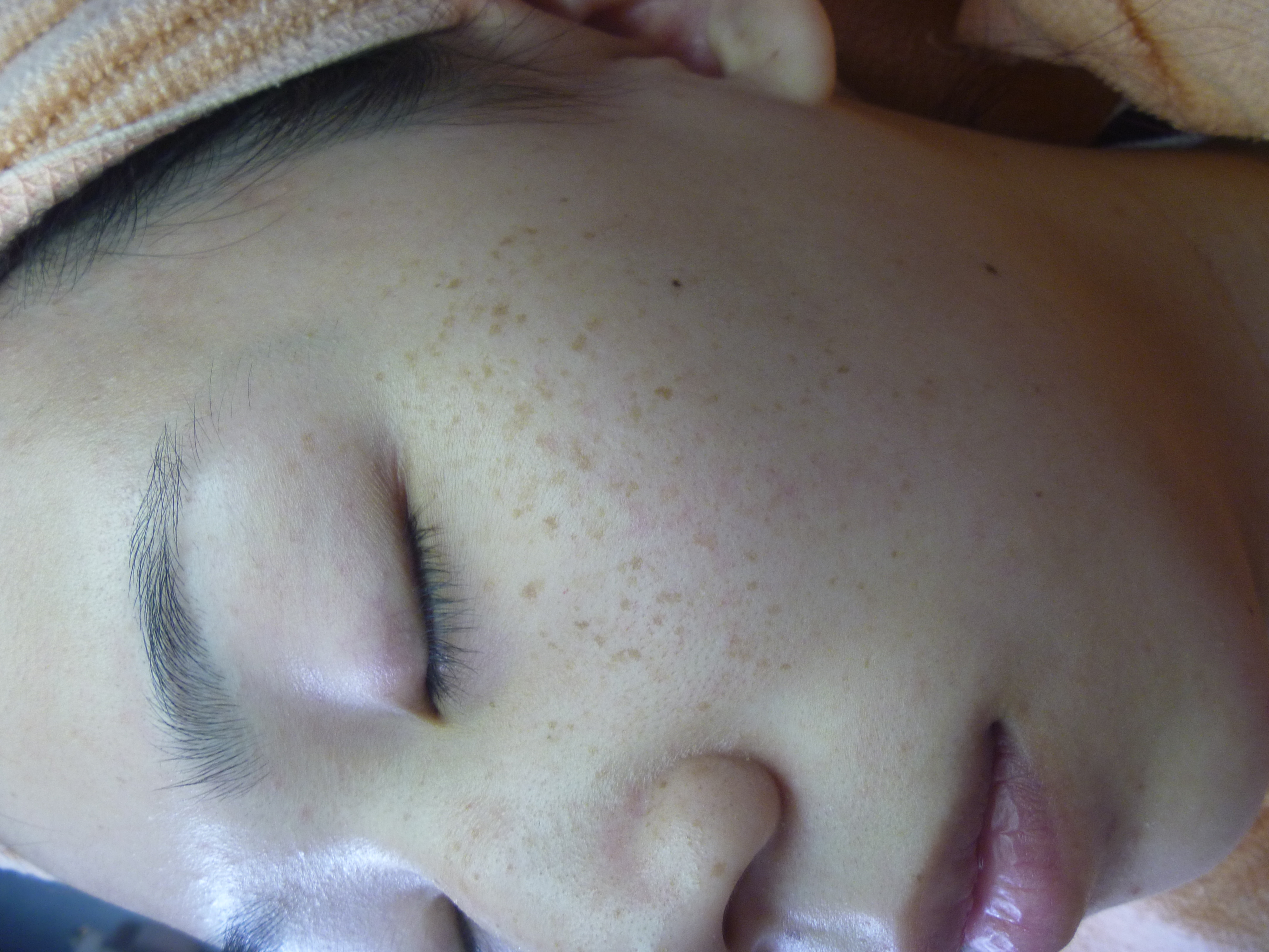 脸上长汗管瘤和斑，深圳什么地方祛除效果最好？(图4)