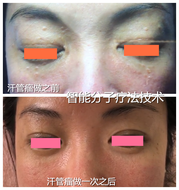 汗管瘤 汗管瘤