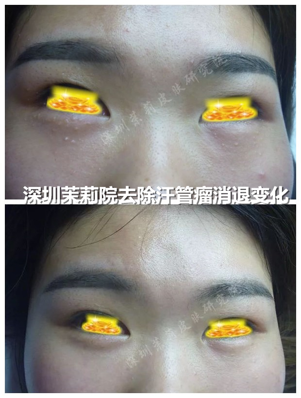 多吃富含核酸食物，对脸上的汗管瘤有好处(图1)