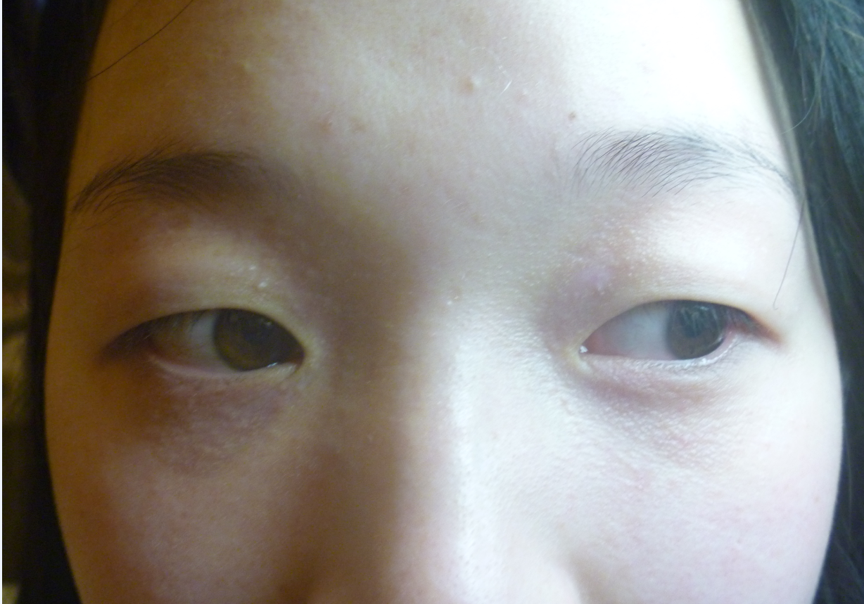 河南16岁女生脸上汗管瘤消退下去,幸好她没有听妈妈的话(图1) 河南16岁女生脸上汗管瘤消退下去,幸好她没有听妈妈的话(图1)