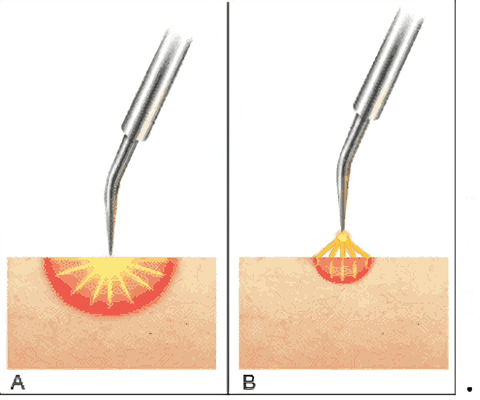 电解法治疗汗管瘤(图1)