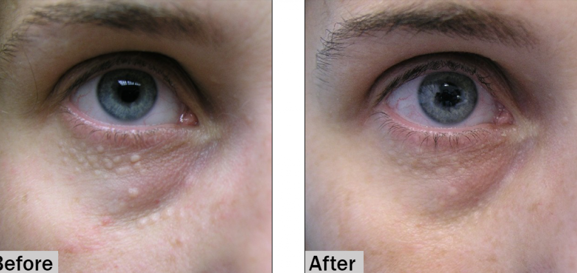 电解法治疗汗管瘤(图2)