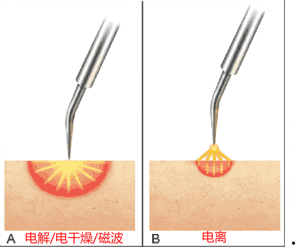 关于汗管瘤的三大误区(图1)